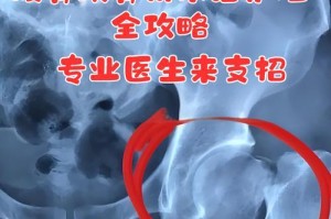 股骨头手术后的恢复时长及注意事项（探究股骨头手术恢复所需的时间、）