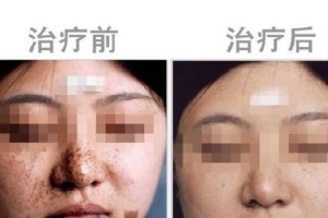黑斑问题（探讨黑斑问题的医疗专业及治疗方法）