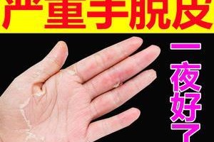 如何治疗以尾巴脱皮的问题？（选择正确的药物来解决以尾巴脱皮的困扰）