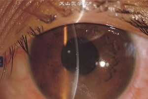 角膜粗糙的原因及预防方法（了解角膜粗糙的成因，保护视力健康）