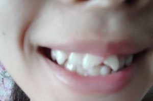 尖尖的牙（探索尖尖牙的功能和特征，了解其生物进化与人类文化的关系）