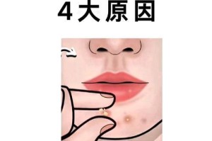 揭秘皮肤病的成因与治疗方法（为什么我们会得皮肤病，如何有效治疗？）