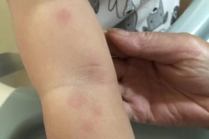 狗引发的荨麻疹（了解狗引发的荨麻疹，保护您和您的宠物健康）
