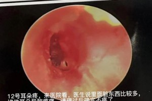 以耳廓炎是什么？（了解症状、诊断和治疗方法）