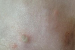 幼犬肚皮下脓包的治疗方法（选择合适的药物帮助幼犬恢复健康）